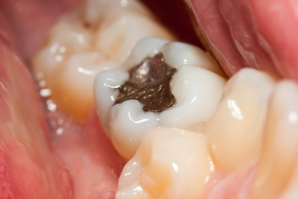 Teeth Fillings in Denver, CO