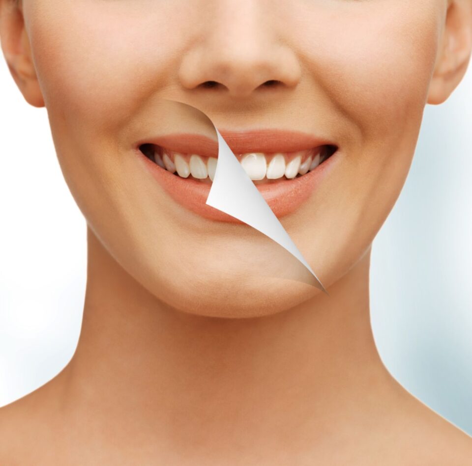 Teeth Whitening in Denver, CO