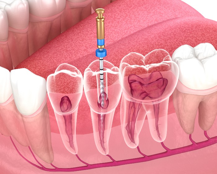 Detailed image of endodontics explained by Reiser Dental in Denver, CO