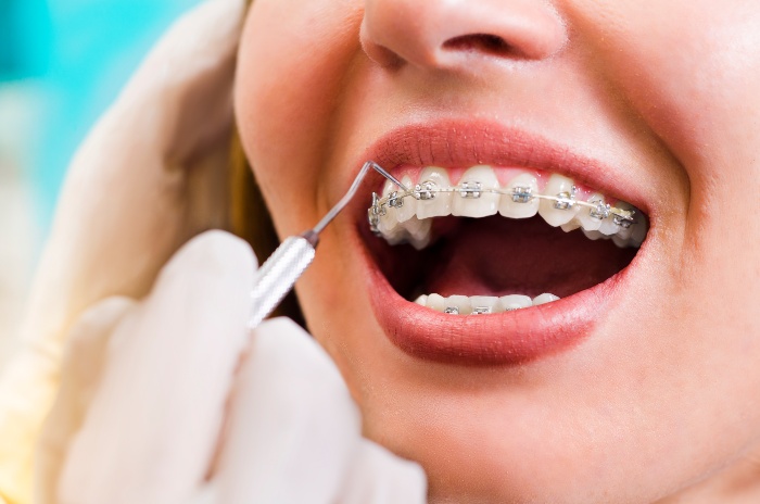 A woman is getting an orthodontic treatment from Reiser Dental in Denver, CO