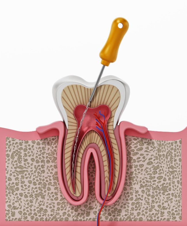 Root Canal Procedures in Denver, CO