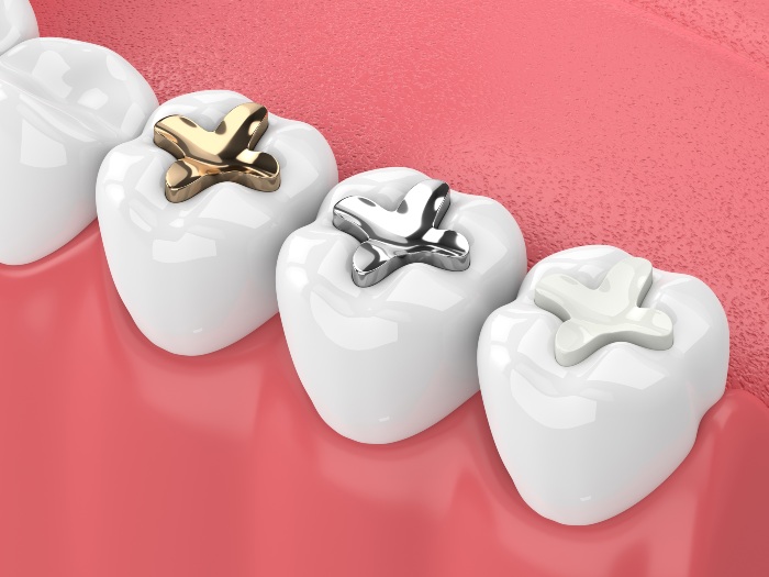 Tooth Colored Fillings in Denver, CO