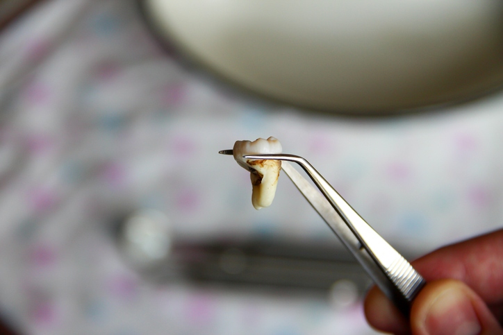 A dentist from Reiser Dental has removed wisdom teeth in Denver, CO