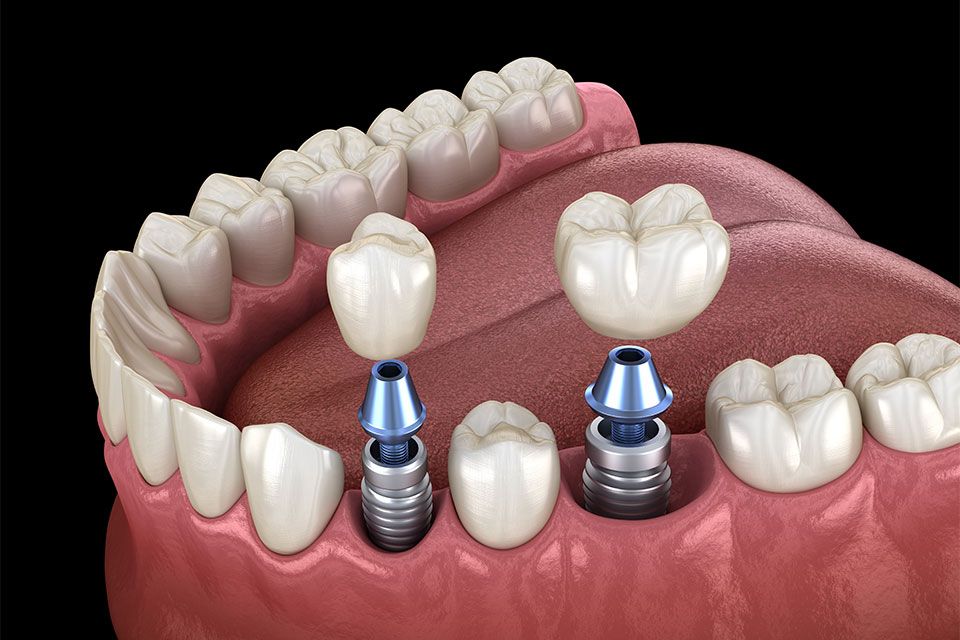 Dental Implants in Denver by Reiser Dental